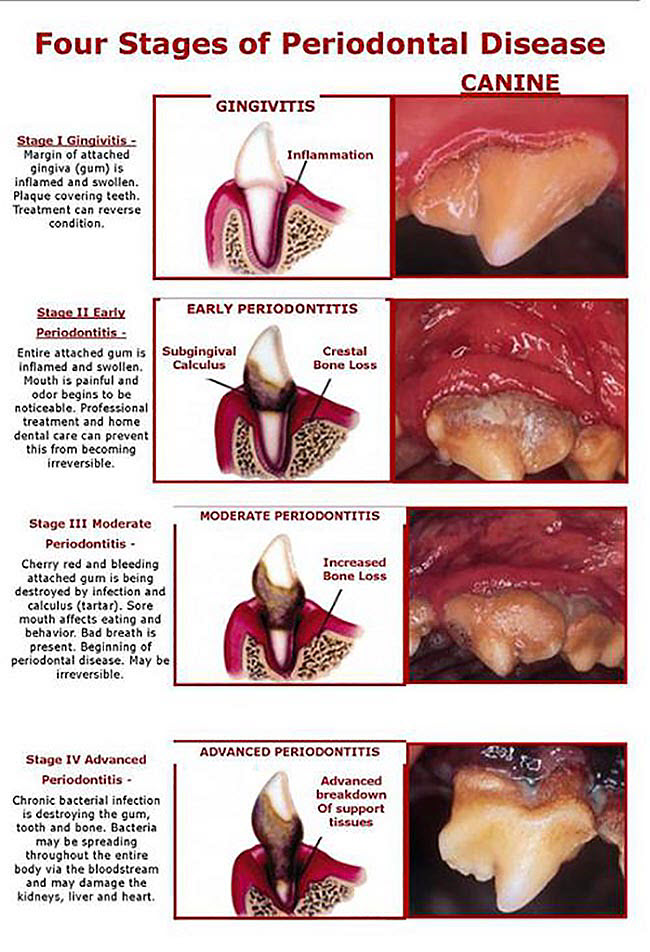 The four grade of periodontal disease